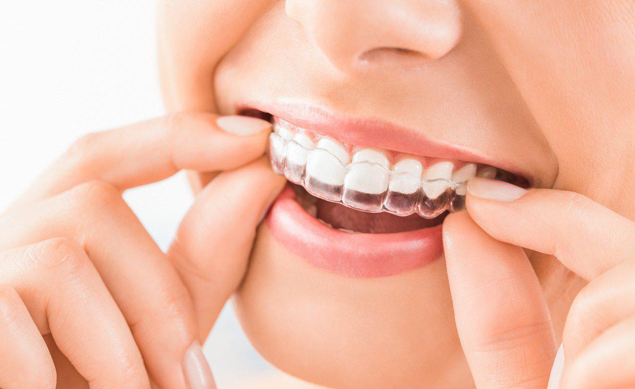 Invisalign Near Me: Everything You Need To Know