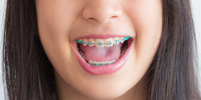 Everything You Need to Know About Braces for Kids