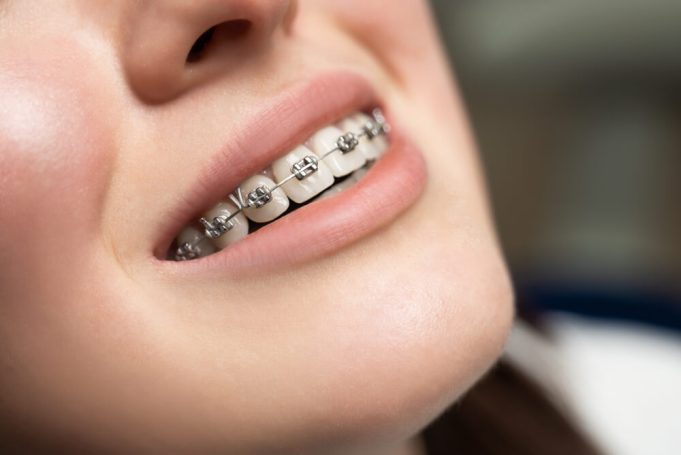 How Long Do You Have To Wear Clear Braces?