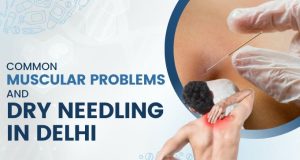 Common Muscular Problems and Dry Needling in Delhi Physiotherapy in Delhi