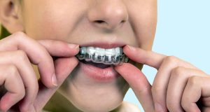 How long does Invisalign take for Minor Adjustments? How long does Invisalign take for Minor Adjustments?