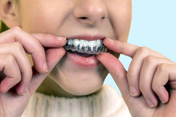 How long does Invisalign take for Minor Adjustments?