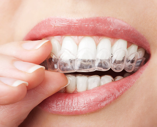 How Long Until Teeth are Straight with Invisalign?