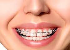 What are the Main Phases of Orthodontic Treatment? What are the Main Phases of Orthodontic Treatment?