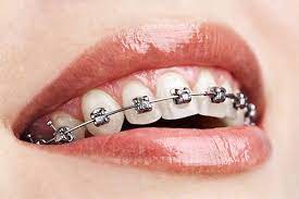 How Do Orthodontists Take Out an Expander?