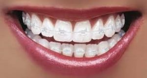 Why do Adults Consider Orthodontic Treatment? Why do Adults Consider Orthodontic Treatment?