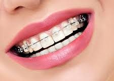 What are the Requirements Before Starting Orthodontic Treatment? What are the Requirements Before Starting Orthodontic Treatment?