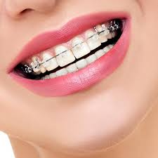 What are the Requirements Before Starting Orthodontic Treatment?