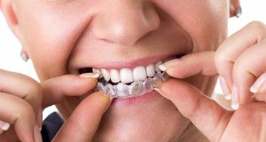 How Do you Get Invisalign when you Can’t Afford It? teen Invisalign in Yulee