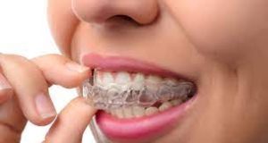 What is The Best Way to Straighten Teeth For Adults? teeth braces for adults in Roanoke